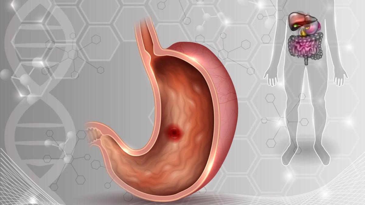 Hiperaciditatea gastrică cauze și remedii