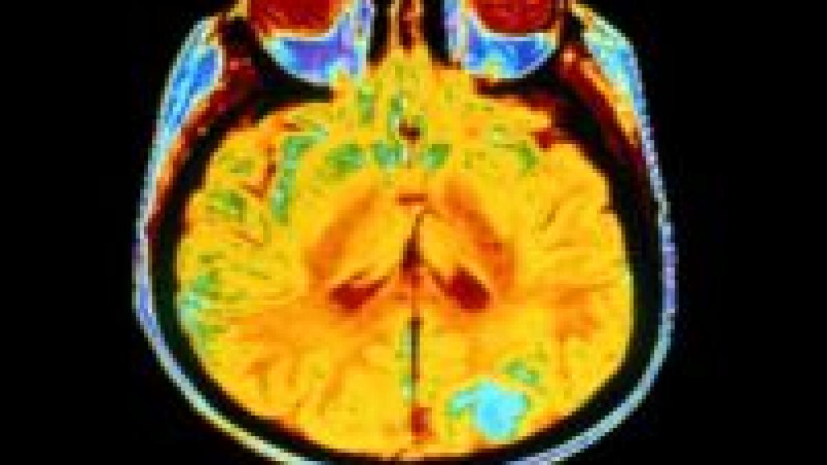 Descoperire: o genă hibrid, vinovată pentru tumorile craniene