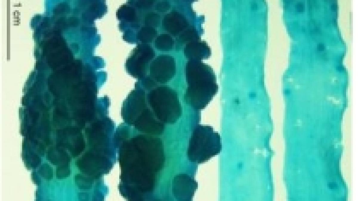 Bacteria care cauzează cancerul la colon, identificată de cercetătorii americani