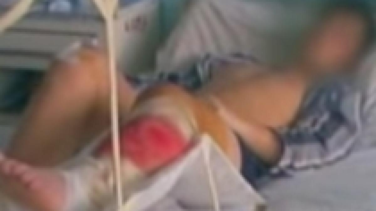 Un tânăr de 16 ani a rămas fără picior pentru că nu a fost operat la timp (VIDEO)