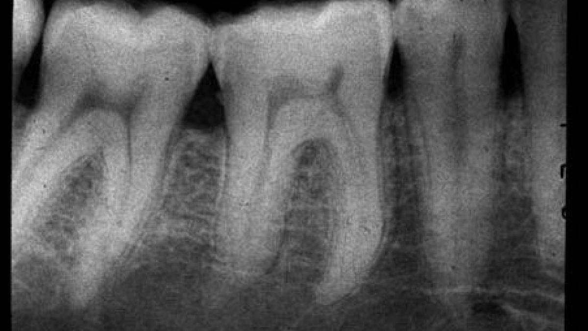 Radiografiile dentare cresc riscul dezvoltării tumorilor cerebrale