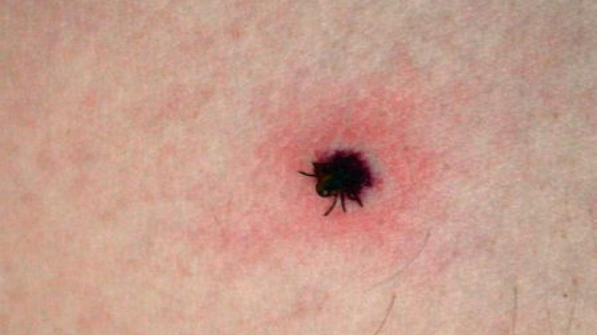 Încă trei cazuri confirmate de boala Lyme în urma muşcăturilor de căpuşe