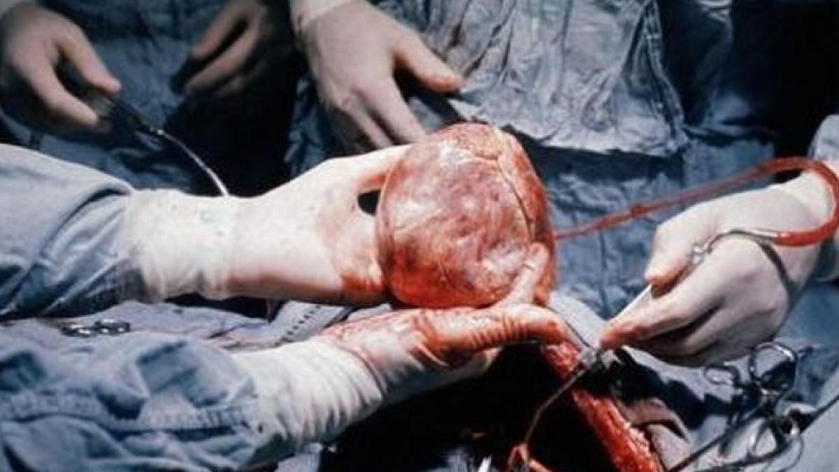 Romania joined the list of countries with the highest number of organ transplants