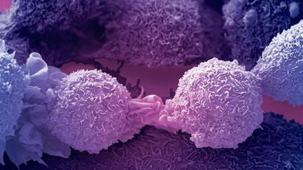 Studiu: Dubla mastectomie nu e indicată în cazul tuturor femeilor diagnosticate cu cancer la un singur sân