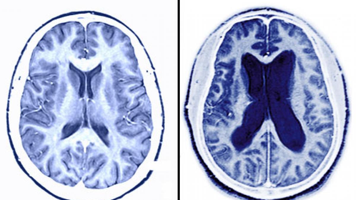 princ_rm_photo_of_alzheimer_brain.jpg