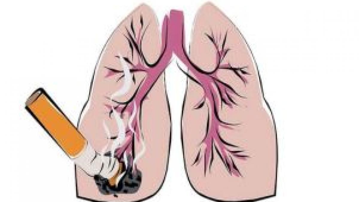 cancer-pulmonar1.jpg