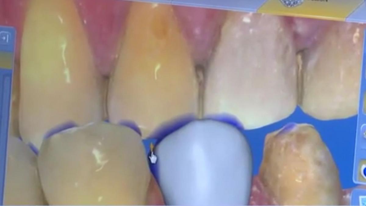 Numai de bine. Faţetele dentare, soluţia rapidă pentru un zâmbet perfect