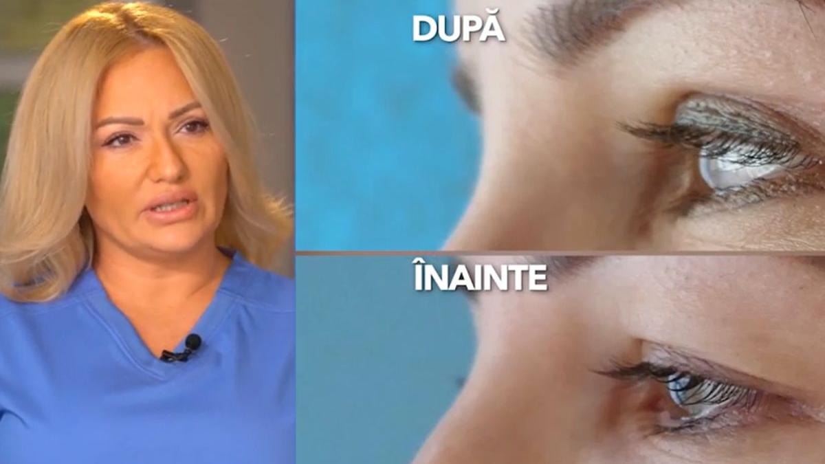 blefaroplastia indepartare exces piele pleoape