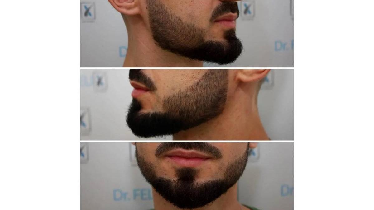 implantul de barba si mustata pentru toti domnii in acelasi loc clinica dr felix hair implant