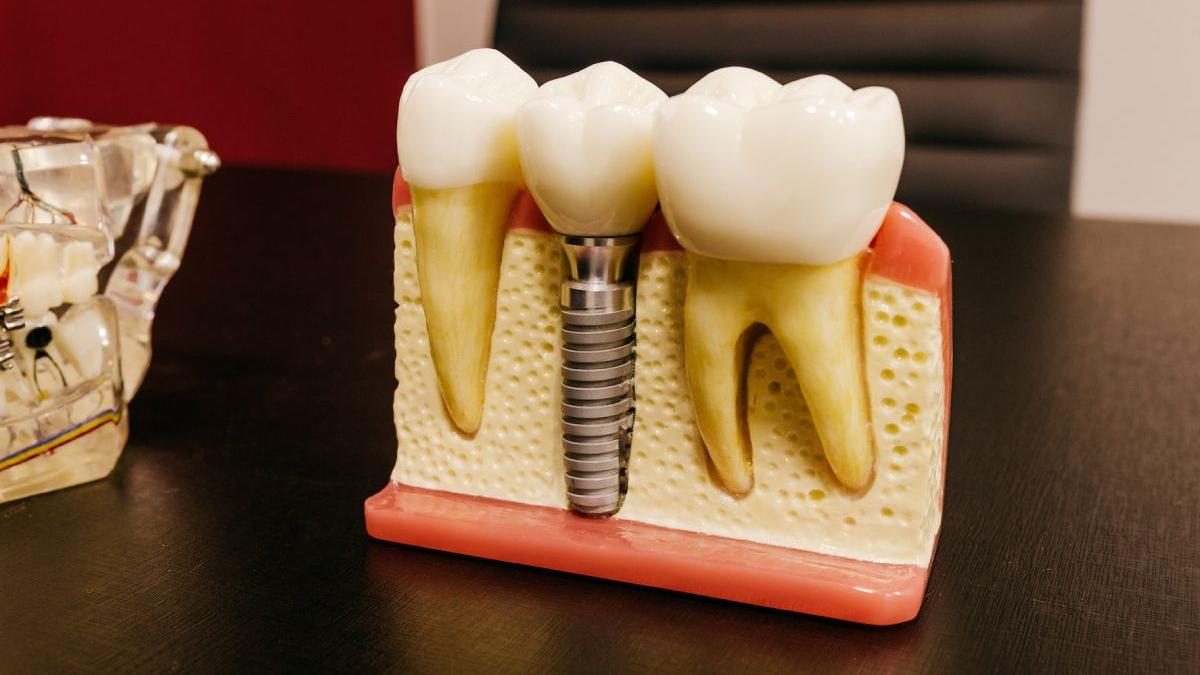 afectiuni orale care pot necesita tratament cu implant dentar