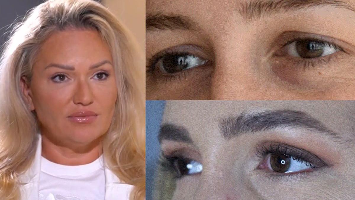 blefaroplastie superioara inferioara cand putem apela la aceasta interventie