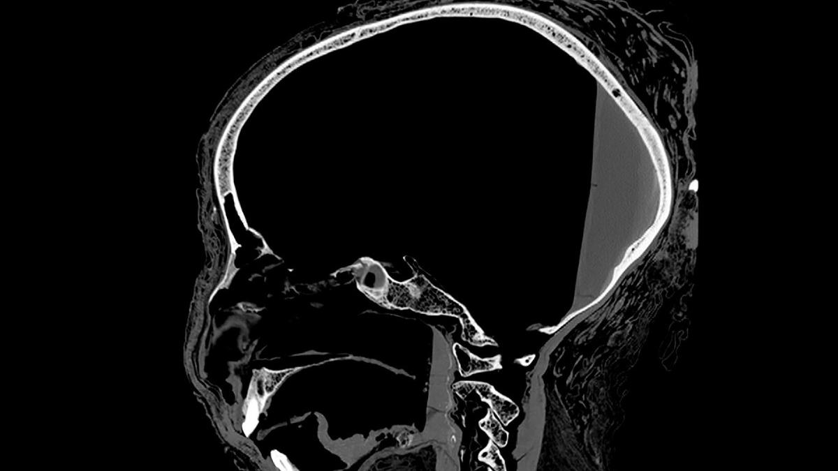 radiografie creier egipteni antici cancer