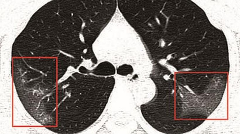 Cum arată radiografia pulmonară a unei tinere cu coronavirus. Medicii, uluiți de viteza cu care virusul înaintează în organism 482