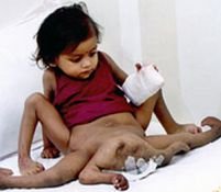 Fetiţa cu patru mâini şi patru picioare a fost operată cu succes <font color=red>(VIDEO ŞI GALERIE FOTO)</font>