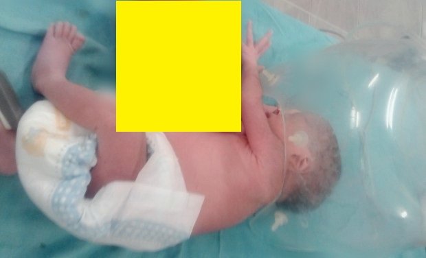 Fetiță născută cu un al doilea cap în zona pieptului, salvată după o operație de patru ore. Atenție, imagini cu un puternic impact emoțional - FOTO