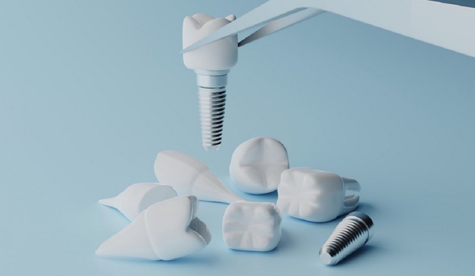 descopera puterea implantului dentar secretul unui zambet de neuitat