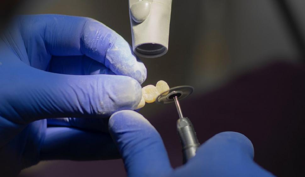 cat de recomandat este implantul dentar pentru inlocuirea dintilor lipsa ce tip de implant