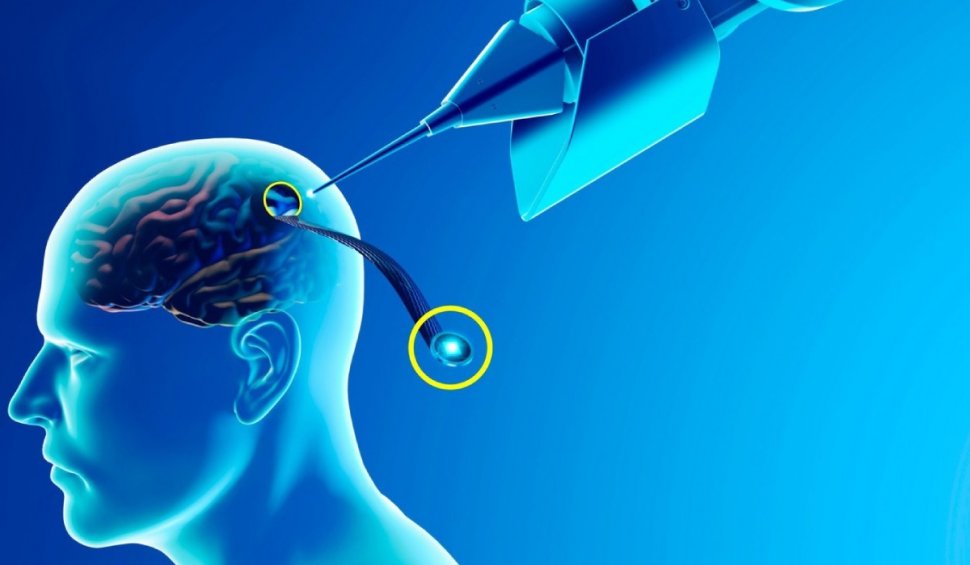 Neuralink a primit aprobarea pentru a implanta un cip cerebral la o a doua persoană. Primul pacient a avut rezultate uluitoare: "Am plâns"