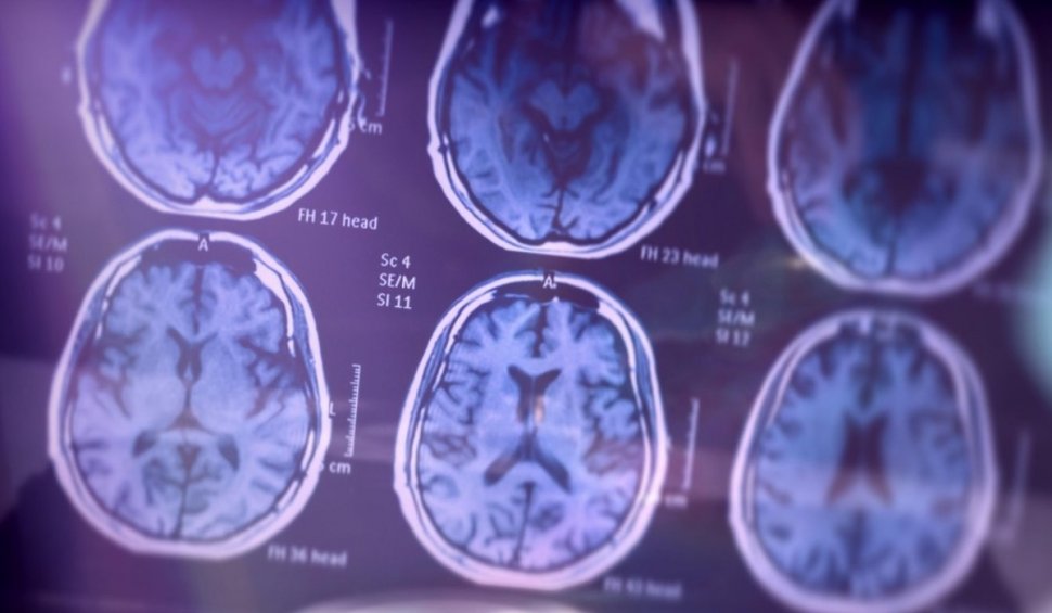Boala Alzheimer ar putea fi diagnosticată din timp prin analize de sânge. Ultimele descoperiri ale cercetătorilor japonezi