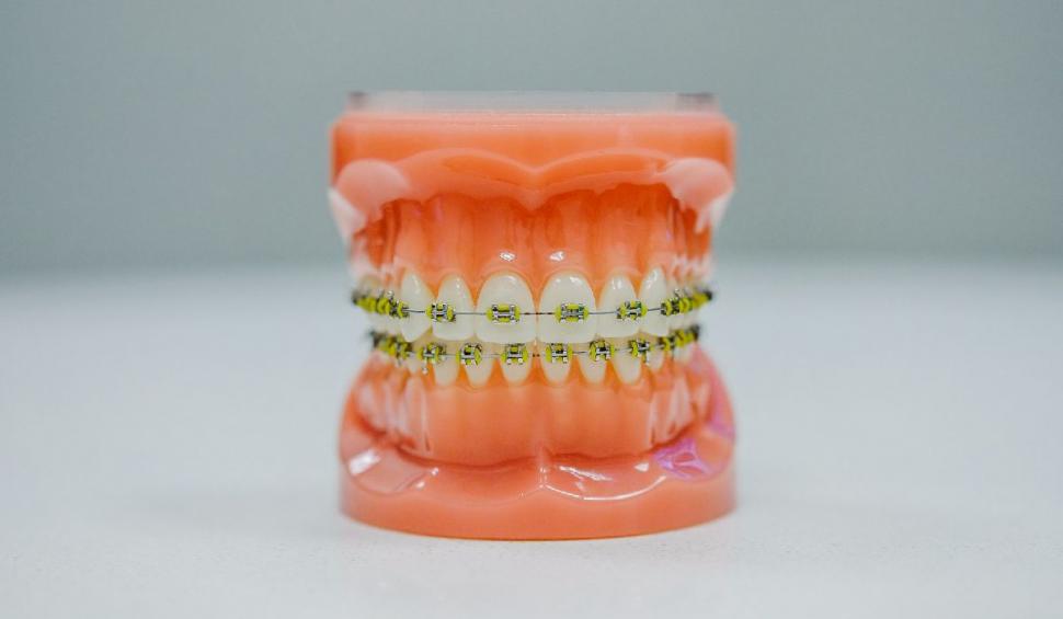 aparat ortodontic
