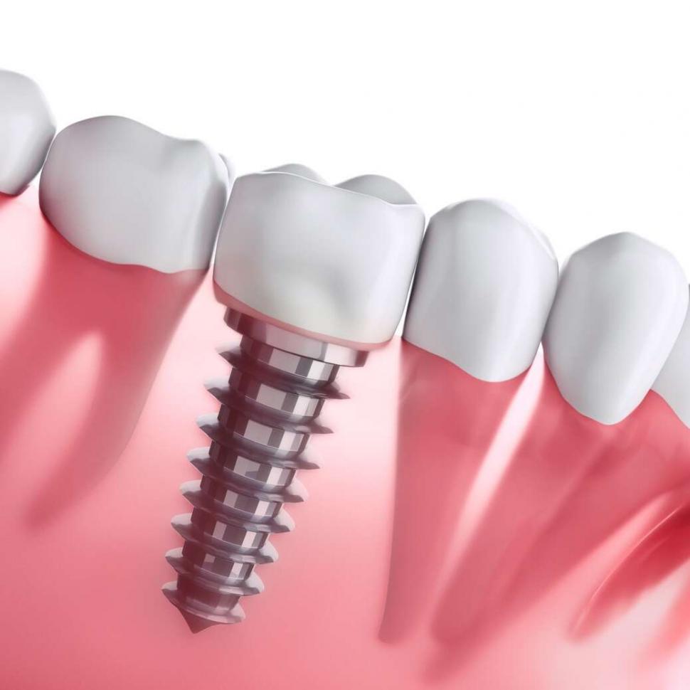 implantdentar (1)