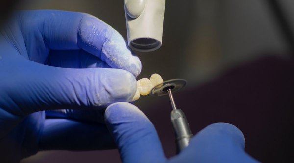 Cât de recomandat este implantul dentar pentru înlocuirea dinților lipsă? Ce tip de implant ți se potrivește