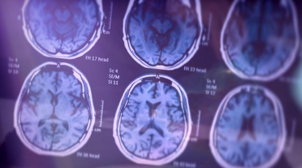 Boala Alzheimer ar putea fi diagnosticată din timp prin analize de sânge. Ultimele descoperiri ale cercetătorilor japonezi