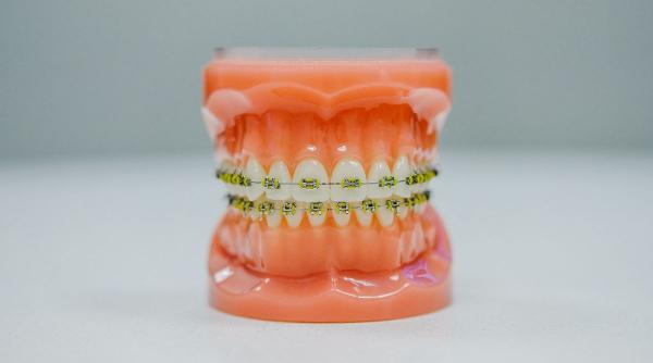 Îngrijirea și întreținerea aparatului dentar: 5 sfaturi utile